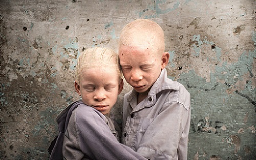 Tanzanie : L’ONU condamne fermement le meurtre d’un bébé albinos