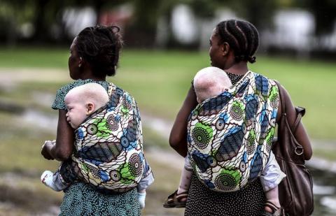 Tanzanie : Des agresseurs coupent la main d’un enfant albinos