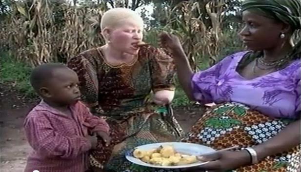 Tanzanie-Justice: Les agresseurs amputent la main d’une femme albinos