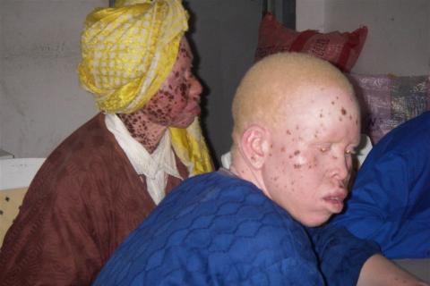 Kenya : Un albinos agressé à la veille de la présidentielle