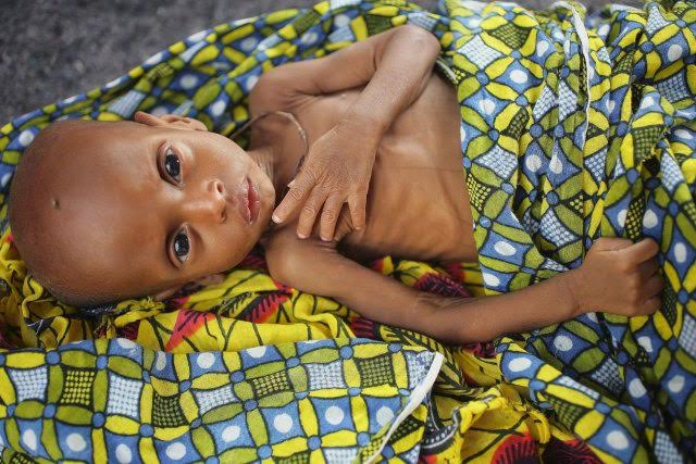 L’ONU lance un nouveau fonds pour combattre la malnutrition en Afrique