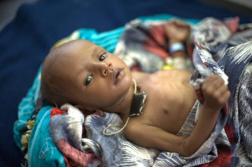 Plus de 6 millions d’enfants en malnutrition chronique en RDC