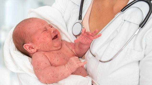 Le ministre allemand de la Santé pense rendre obligatoire le vaccin contre la rougeole