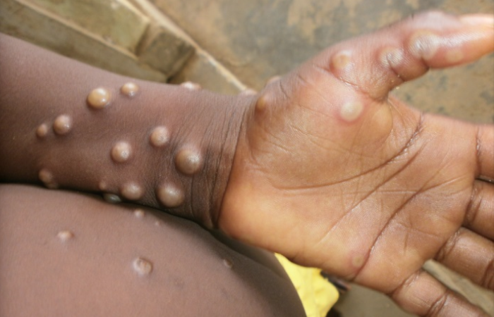 Un premier cas de variole du singe confirmée au Soudan