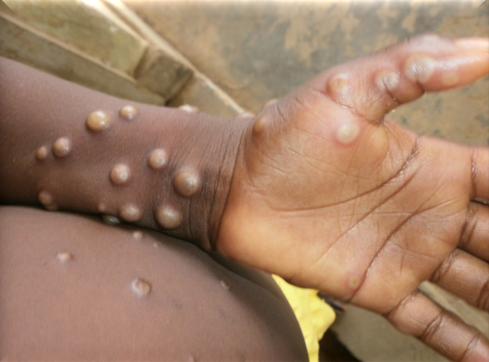L’Ethiopie renforce la prévention contre la variole du singe