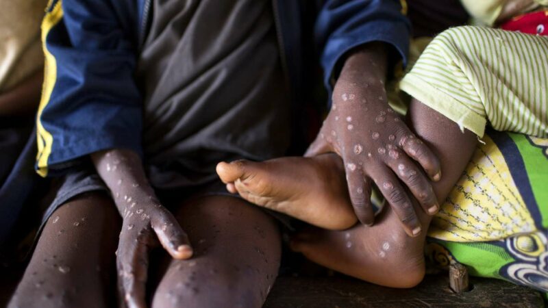 La variole du singe s’étend à la région Sud-ouest du Cameroun
