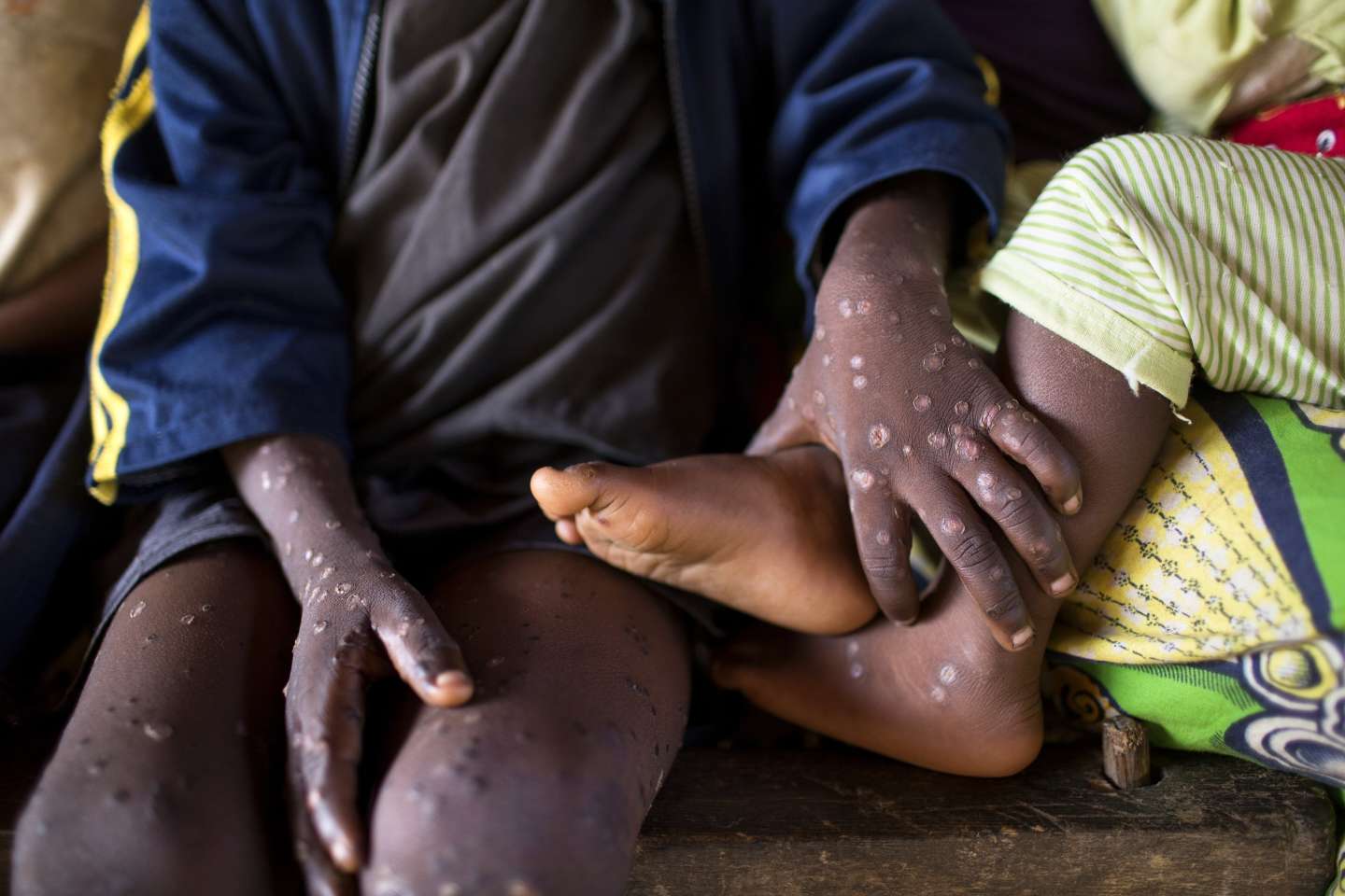 La variole du singe s’étend à la région Sud-ouest du Cameroun