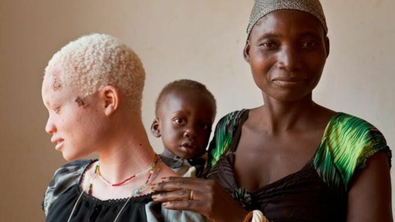 Tanzanie : Des ONG repartent en guerre contre le sort incertain des albinos