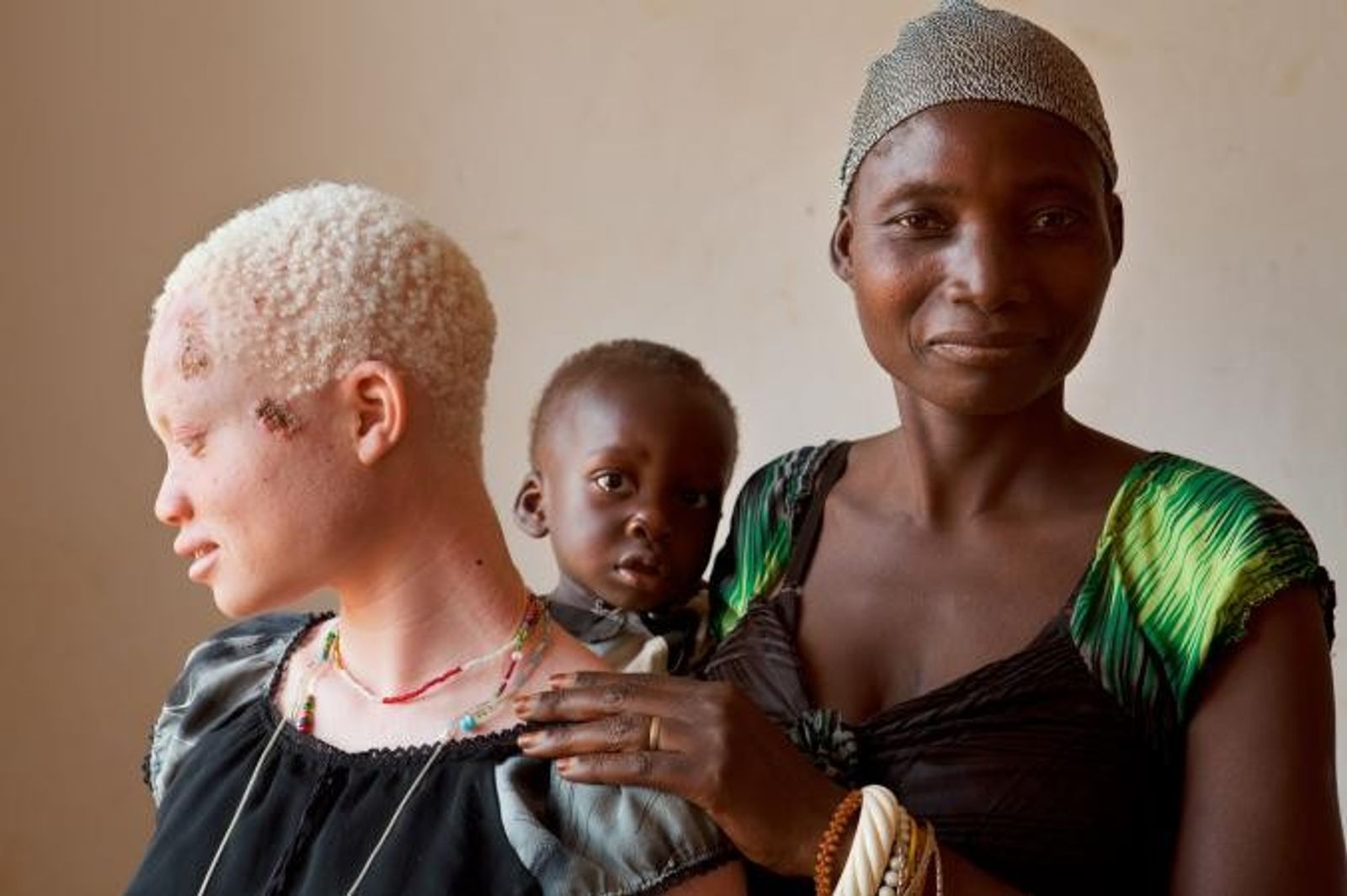 Tanzanie : Des ONG repartent en guerre contre le sort incertain des albinos
