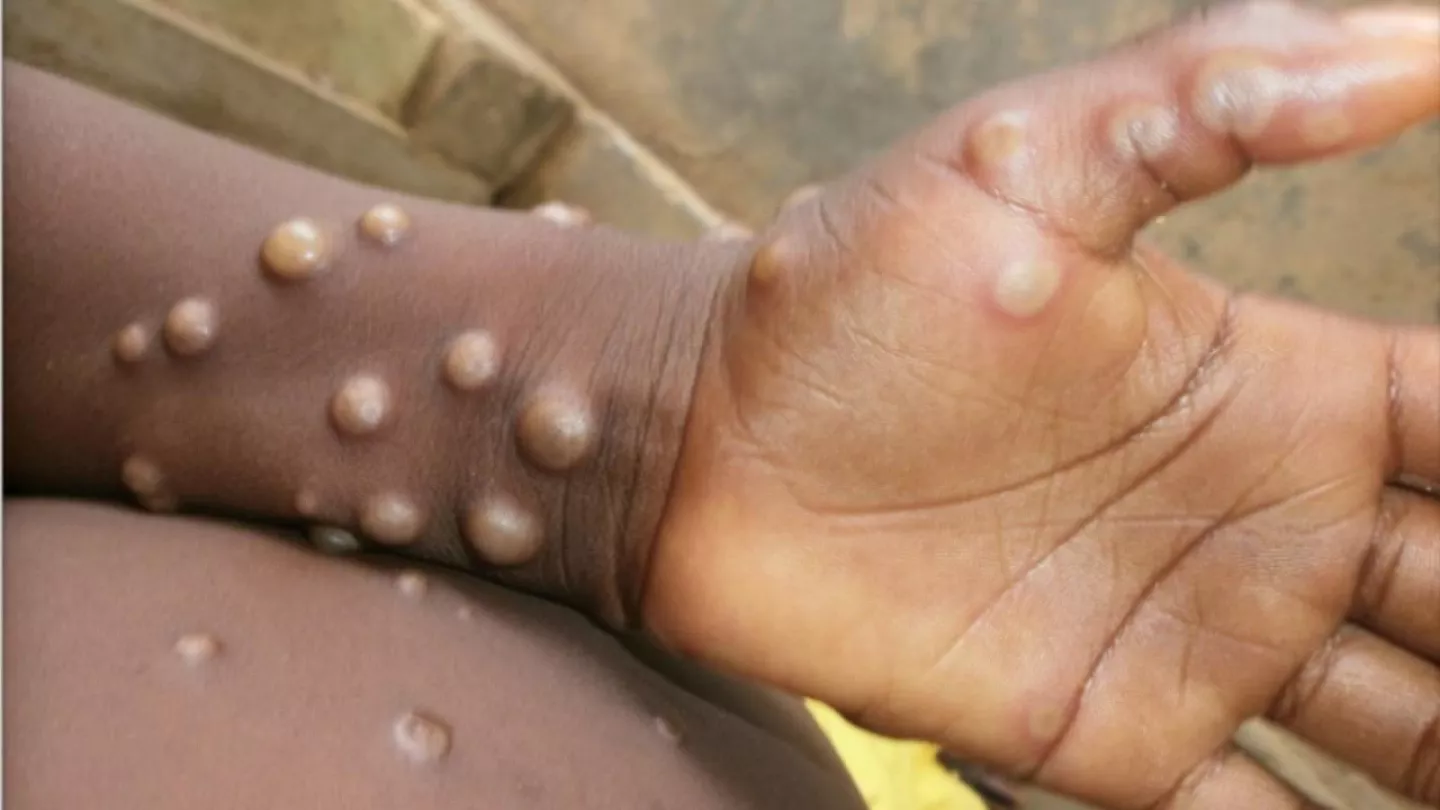 L’UE octroie à la RDC, une aide de 350.000 euros pour la lutte contre l’épidémie de Monkeypox