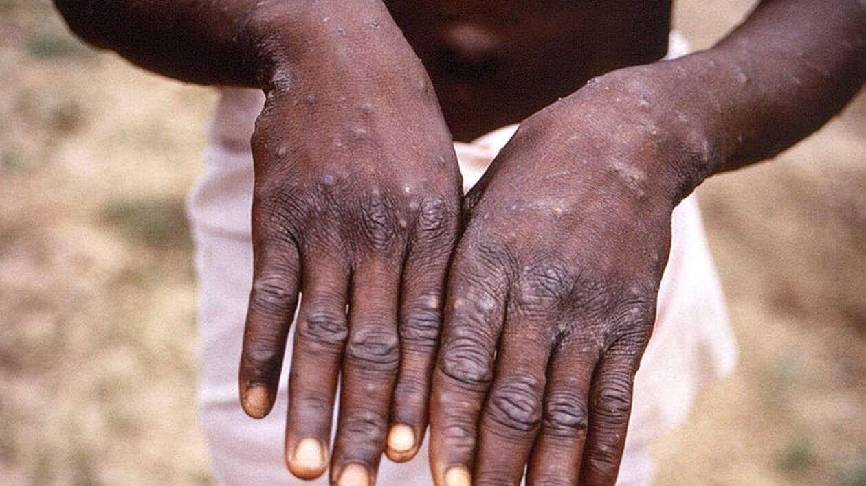 La variole du singe  sévit dans 30% des zones nationales de santé de la RDC